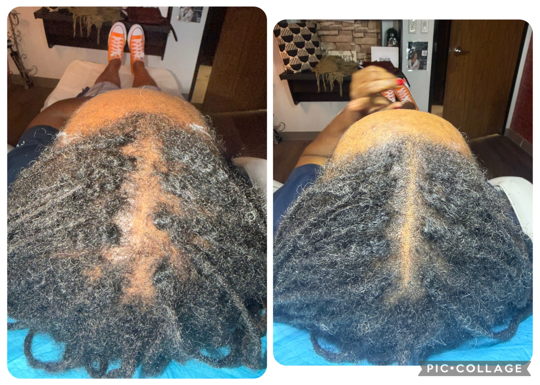CASE 004 before and after — Women, Density, Multicultural Results, Diffuse Thinning