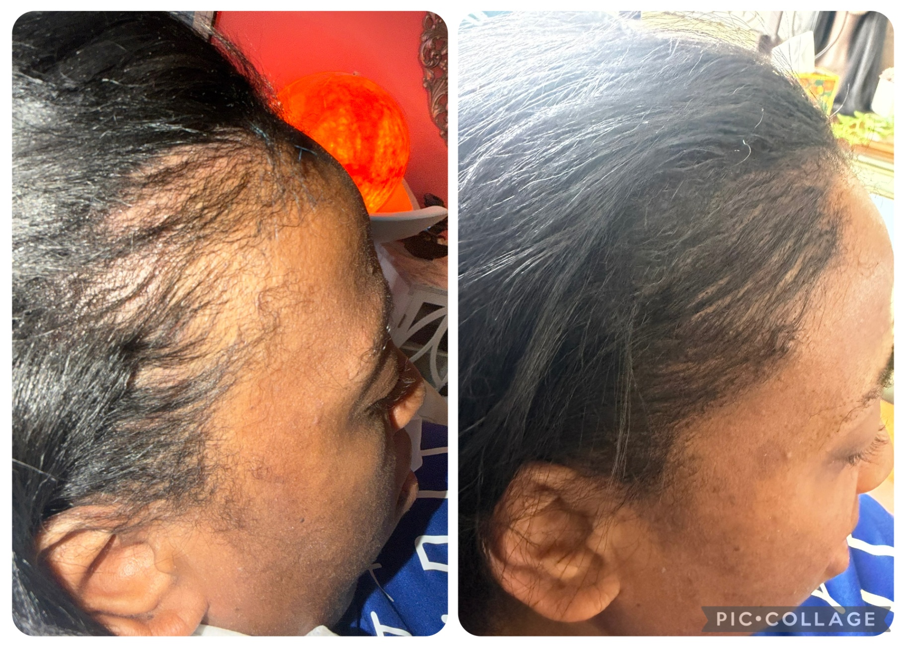 CASE 003 before and after — Women, Hairline, Multicultural Results, Diffuse Thinning