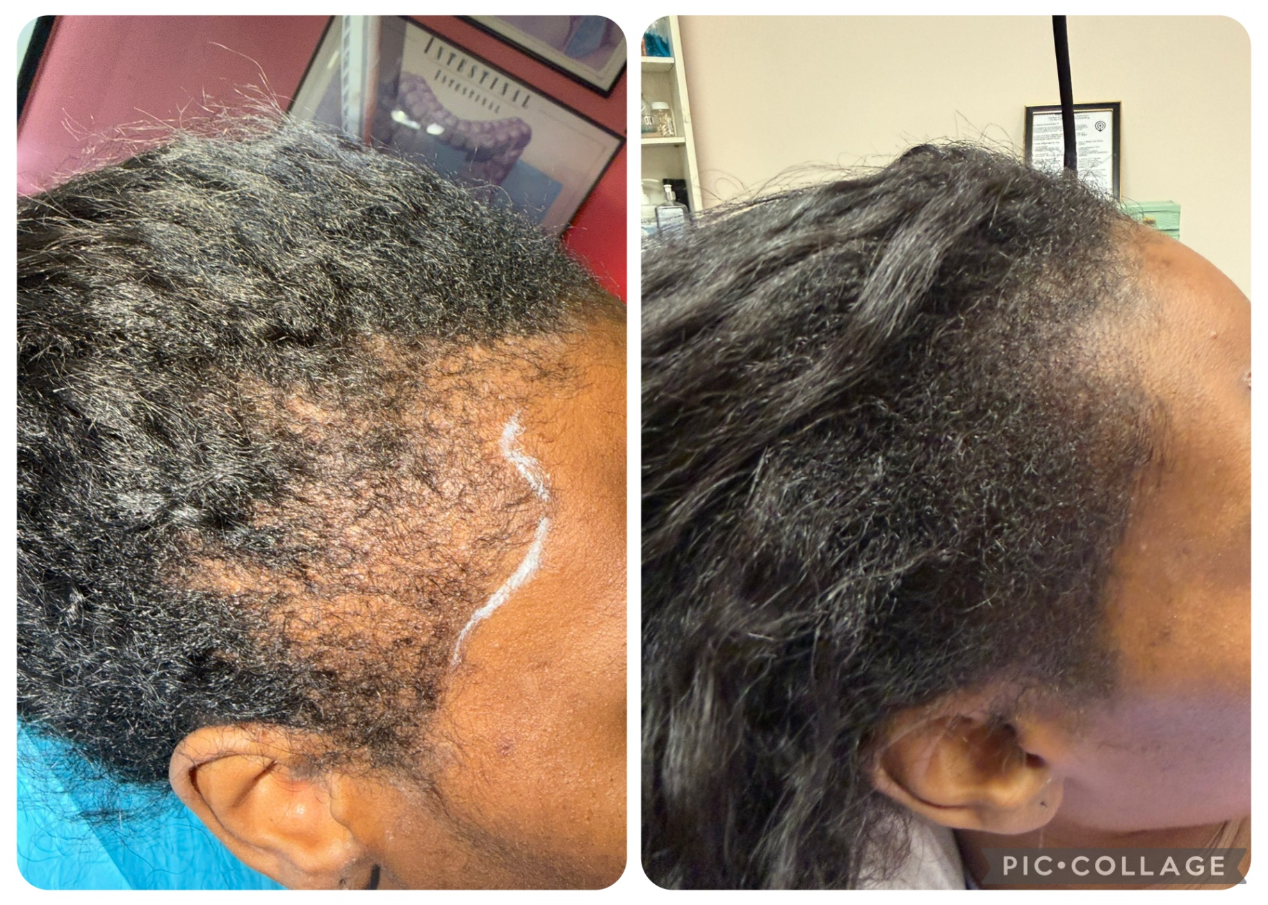 CASE 002 before and after — Women, Hairline, Multicultural Results, Corrective