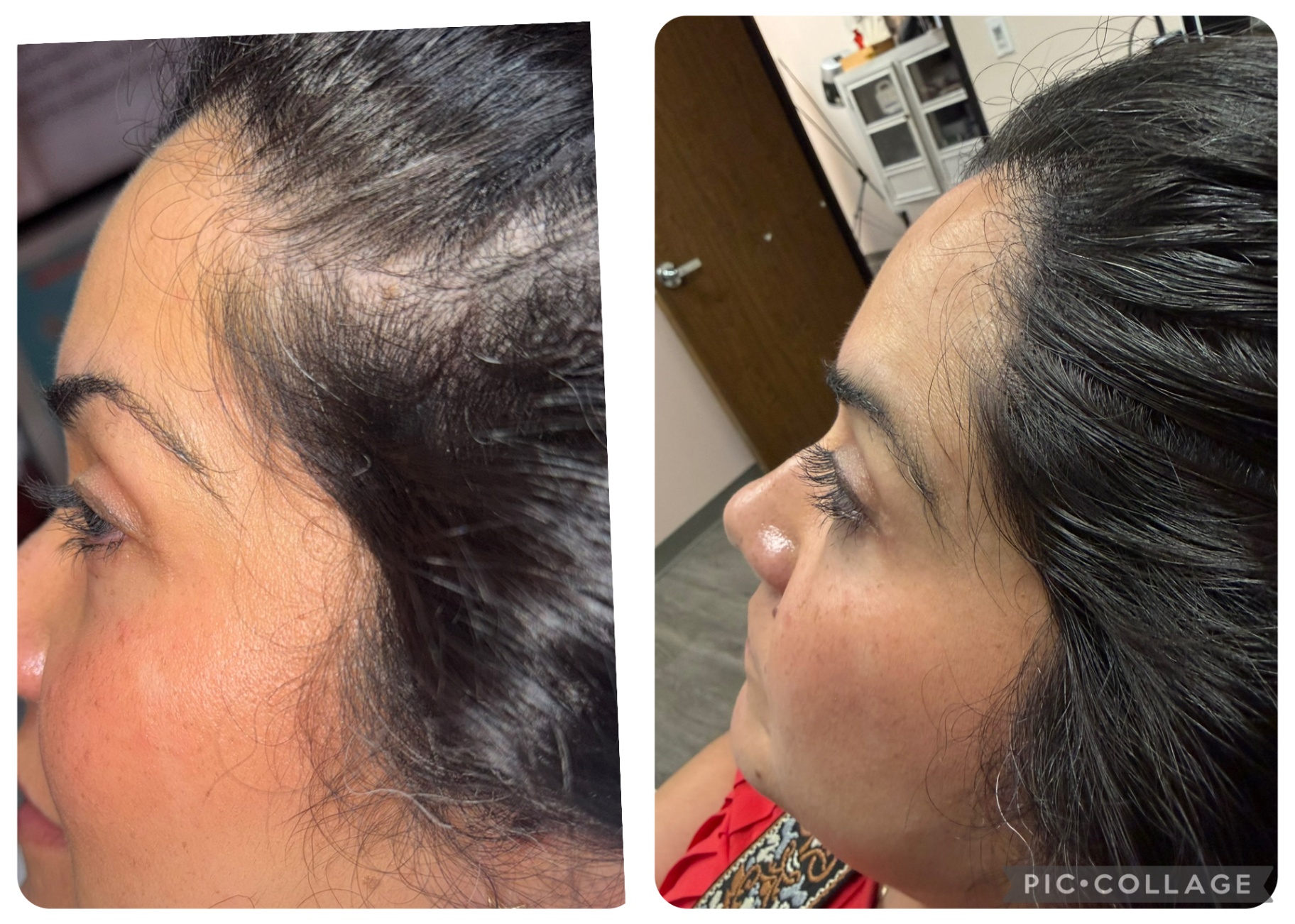 CASE 006 before and after — Women, Hairline, Diffuse Thinning, Density